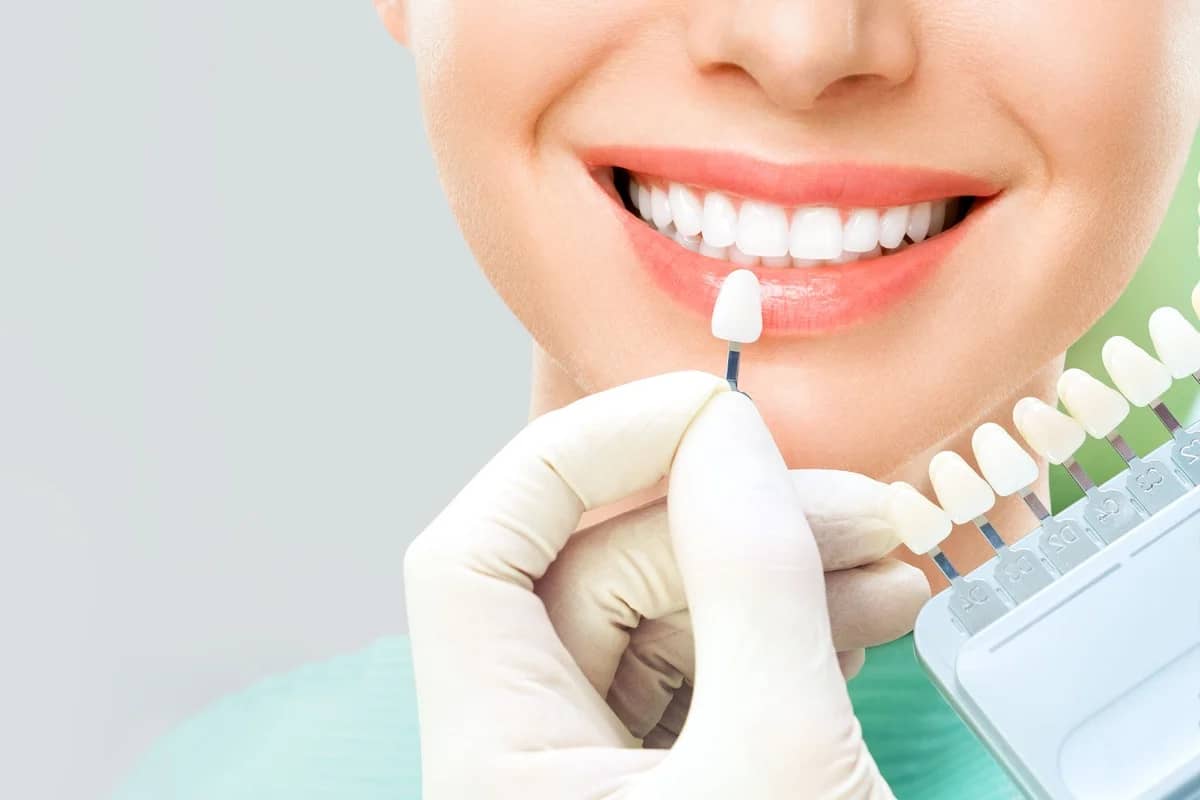 Lentes de contato dental e facetas de porcelana