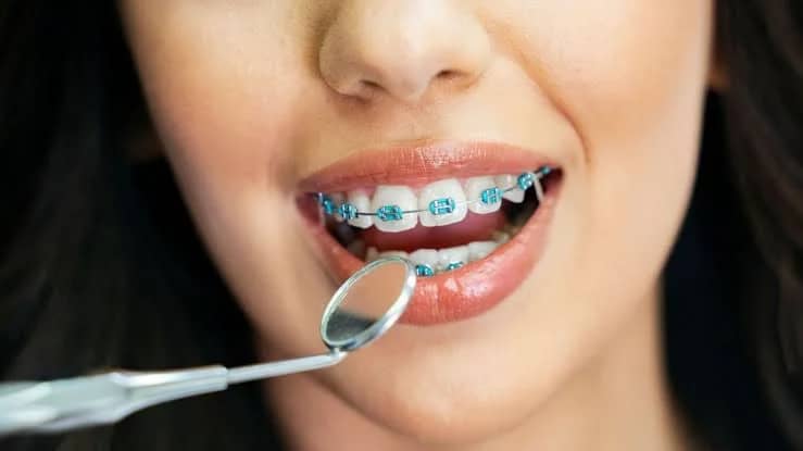 Tratamento ortodôntico com aparelhos e alinhadores