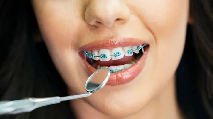 Tratamento ortodôntico com aparelhos e alinhadores